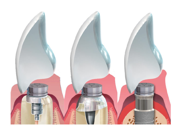 Dyna Dental ServoDental